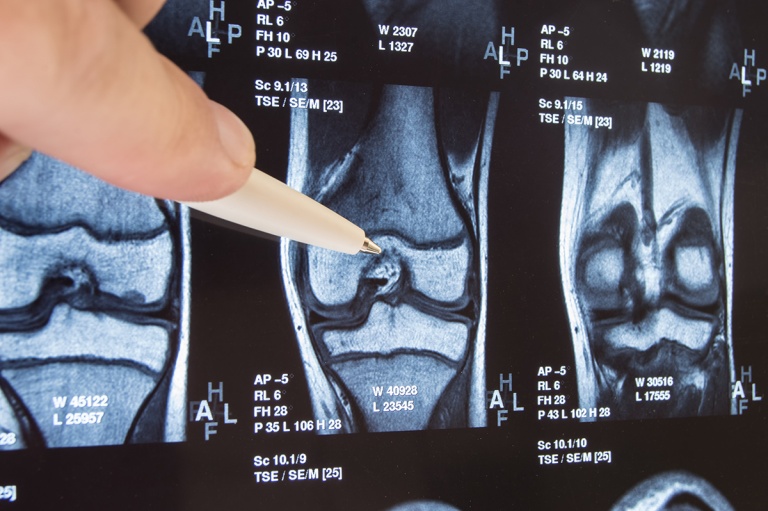 Knee Joint X Ray Or MRI Doctor Pointed On Area Of Knee Joint Where